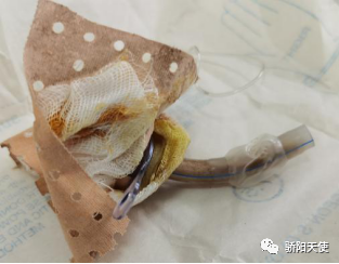 12.12更换的一次性气管套管